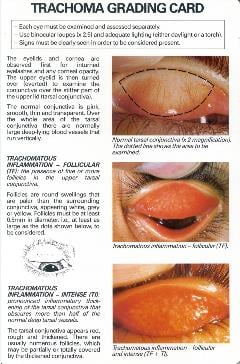 Trachoma-simplified-grading-card-verso-Eng