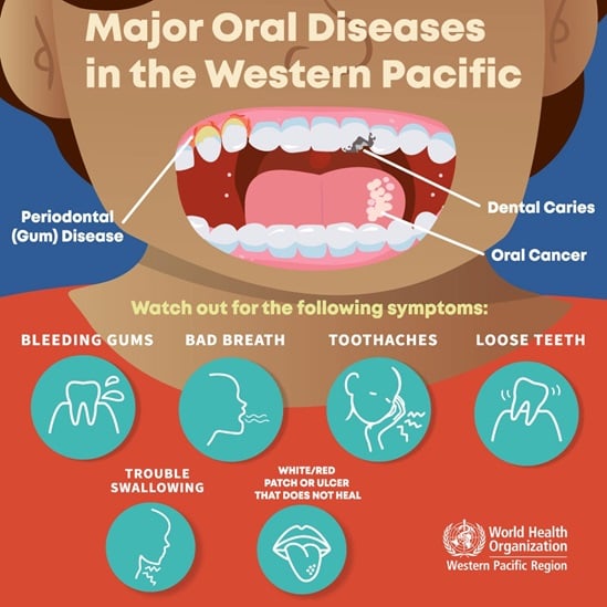 Major oral diseases in the Western Pacific Region